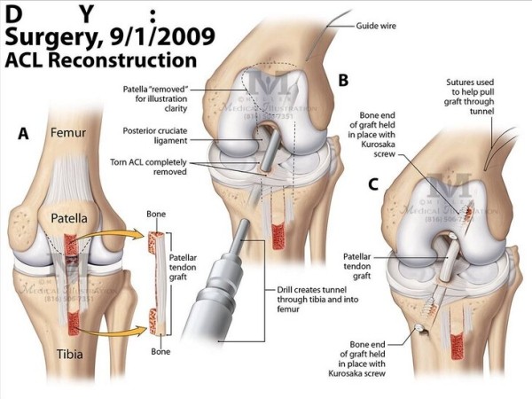 Златан – лев, но колени его измучили. Не спал из-за боли, жидкость откачивали каждую неделю